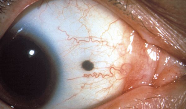 Голубой невус конъюнктивы [18]