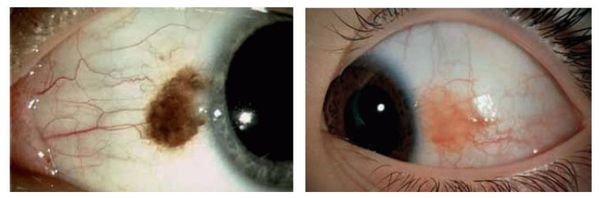 Как может выглядеть невус конъюнктивы [22]