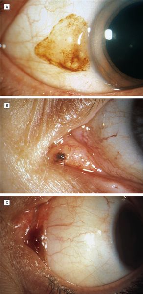 Невус в области лимба, слёзного мясца и полулунной складки [18]