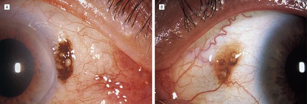 Невусы конъюнктивы с кистами [18]