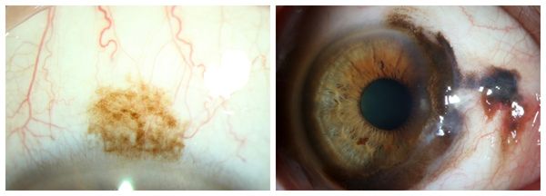 Первичный приобретённый меланоз и меланома конъюнктивы [1]
