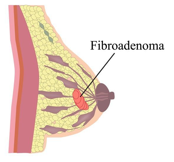 Фиброаденома