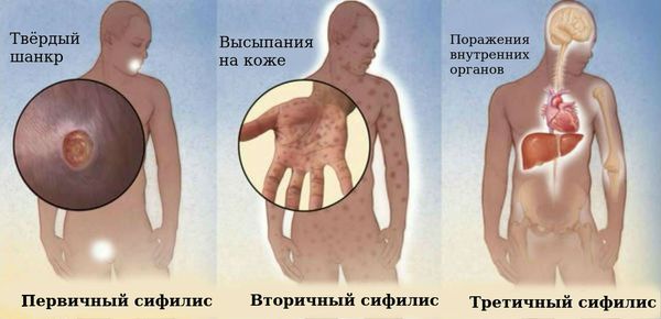 Сифилис. Симптомы и признаки сифилиса