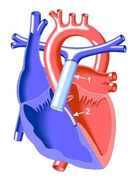 1. Кондуит 2. Закрытый заплатой дефект межжелудочковой перегородки