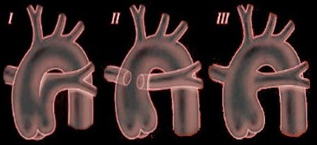 Типы общего артериального ствола [20]