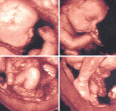 Обвитие пуповиной разных частей тела плода (3D-УЗИ) [15]