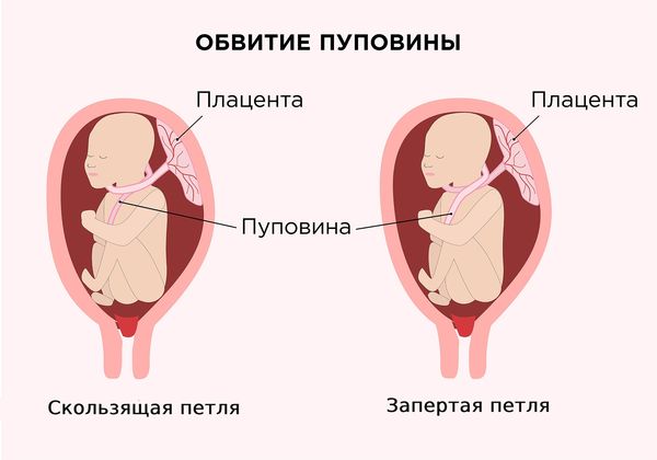 здоровая плацента и пуповина