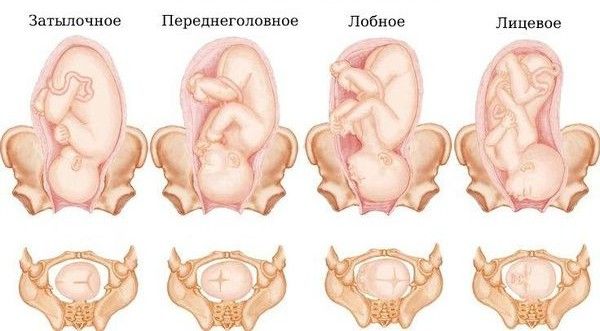 Виды головного предлежания плода