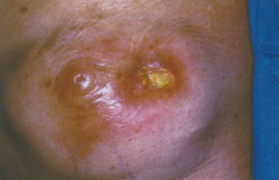 Олеогранулёма: стадия абсцедирования Олеогранулёма: стадия абсцедирования