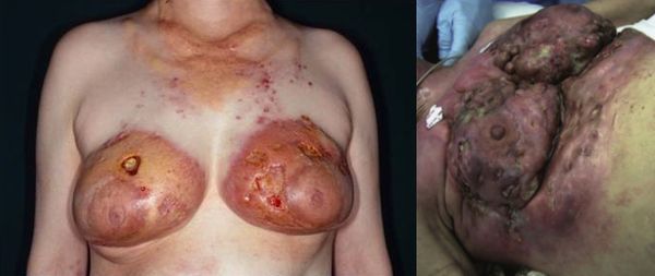 Ответная реакция кожи на введение силикона в грудь Ответная реакция кожи на введение силикона в грудь