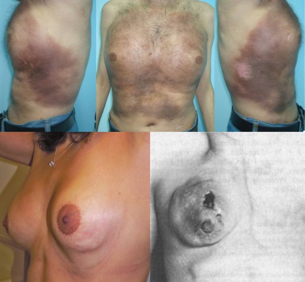 Признаки олеогранулёмы Признаки олеогранулёмы