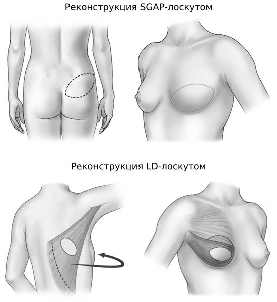 Реконструкция груди SGAP- и LD-лоскутом