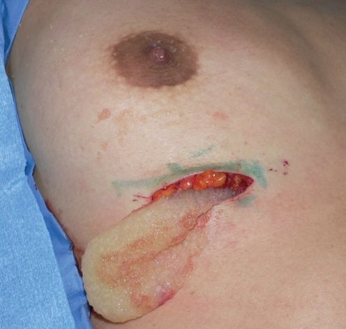 Удаление филлера Удаление филлера