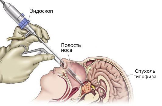 Операция по удалению опухоли гипофиза Операция по удалению опухоли гипофиза
