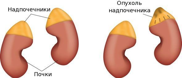Опухоли надпочечников Опухоли надпочечников