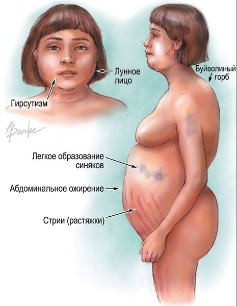 Симптомы болезни Иценко — Кушинга