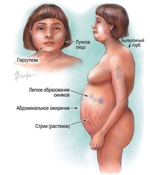 Симптомы болезни Иценко — Кушинга Симптомы болезни Иценко — Кушинга