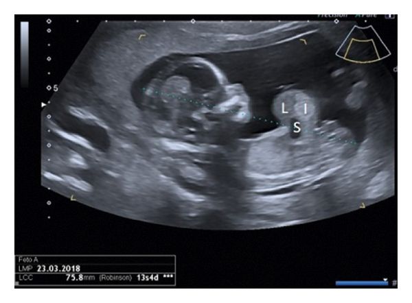 Омфалоцеле на УЗИ [13]