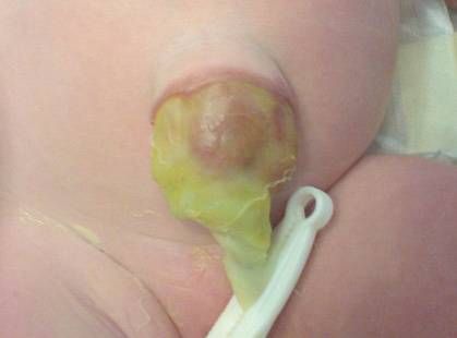 Омфалоцеле, покрытое оболочкой [12]