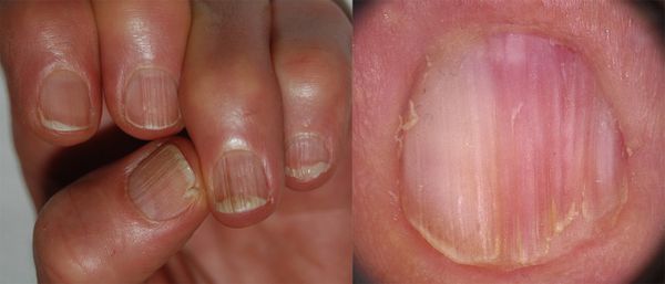 Ониходистрофия (дистрофия ногтей): причины, симптомы и лечение в статье  дерматолога Кривда В. А.