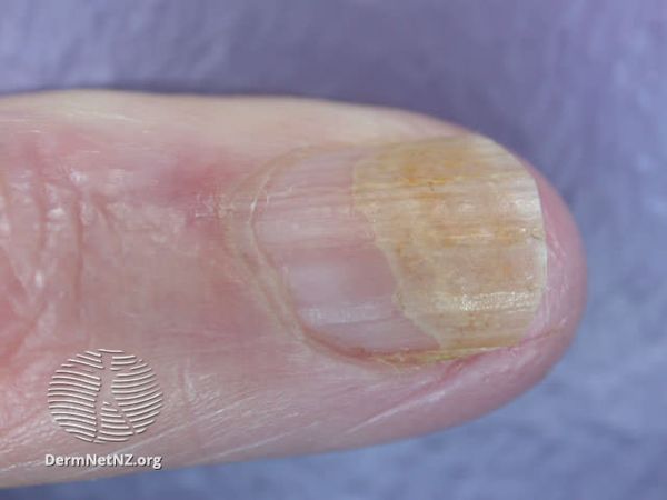 Как проходит лечение онихолизиса (отслоения ногтевой пластины) в PODOcenter