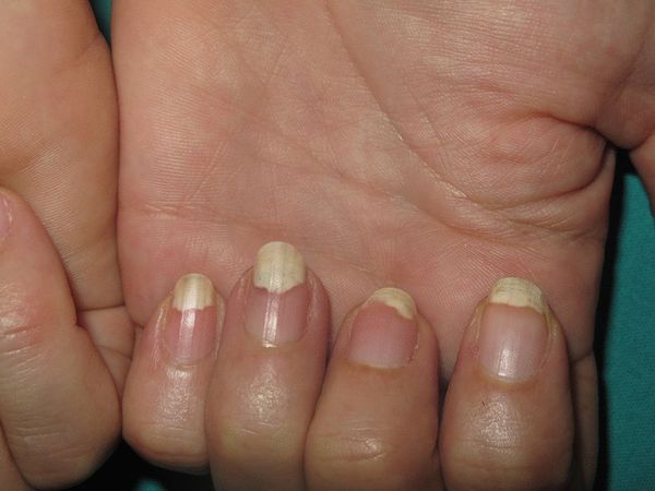 Черные полоски на ногте в виде заноз - Вопрос дерматологу - 03 Онлайн