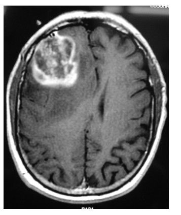 Глиобластома на МРТ [20]
