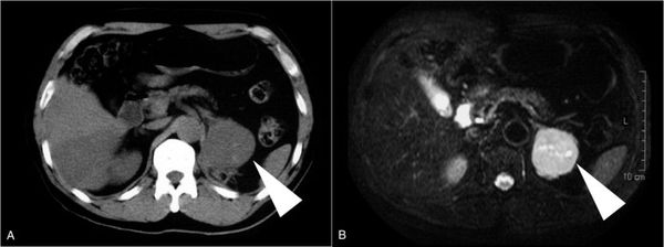 Опухоль надпочечника на снимках МРТ и КТ