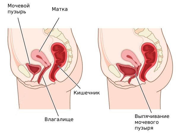 Опущение и выпадение матки: симптомы, причины, диагностика.