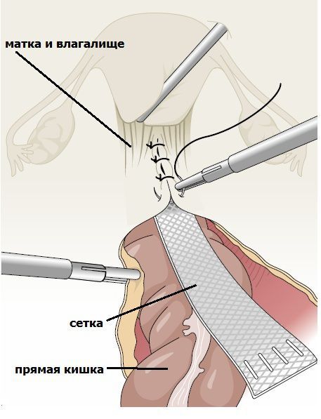 Имплант фиксируется над стенкой прямой кишки для укрепления задней стенки влагалища