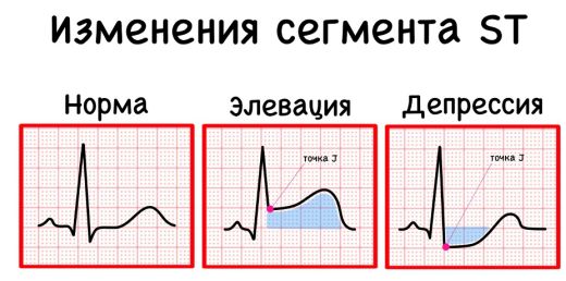 ЭКГ при ОКС