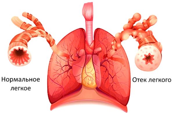 Отёк лёгкого