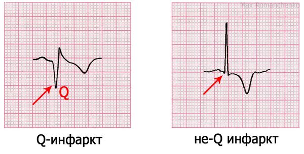 Патологический зубец Q