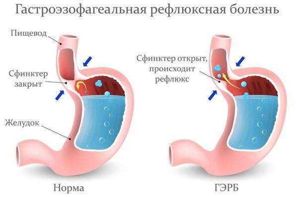 У ребенка горловой кашель что делать