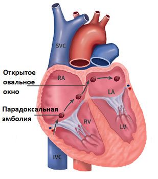 Открытое овальное окно - лечение эндоваскулярными методами в отделении института Амосова.