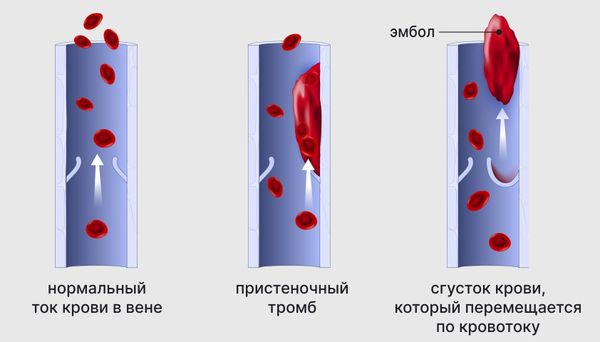 Открытое овальное окно - катастрофа?