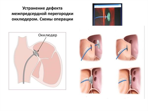 Открытое овальное окно в сердце в Израиле