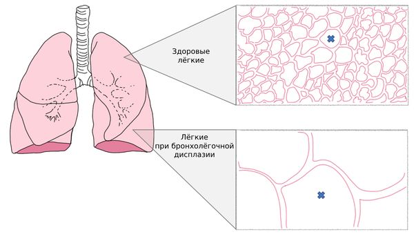 Бронхолёгочная дисплазия Бронхолёгочная дисплазия