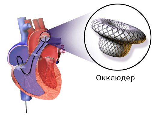 Эндоваскулярная окклюзия Эндоваскулярная окклюзия
