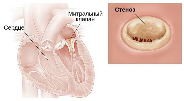 Стеноз митрального клапана Стеноз митрального клапана
