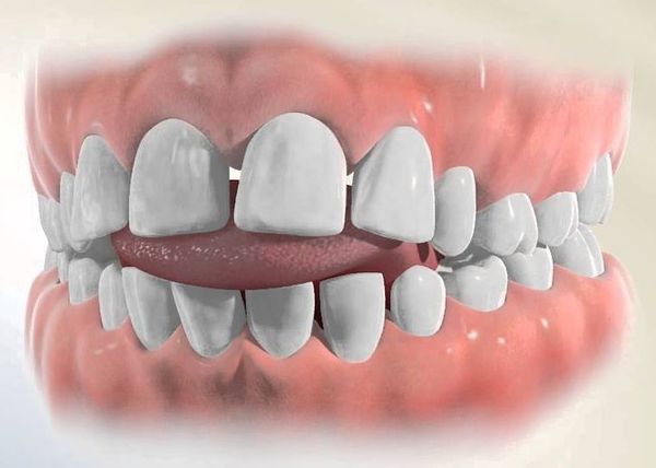 Прокладывание языка в промежуток между зубами