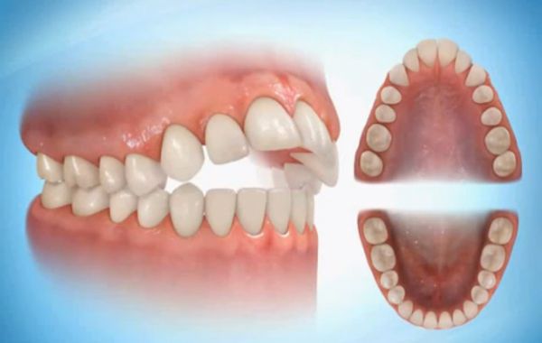Смыкание зубов при открытом прикусе