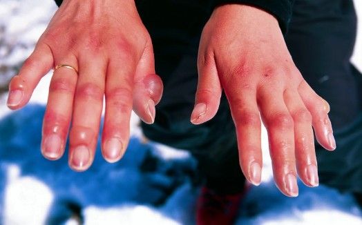 Волдыри с прозрачной жидкостью [11]