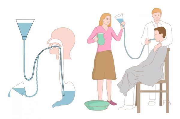 Промывание желудка с помощью зонда [15]