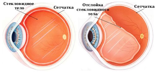 Отслойка стекловидного тела