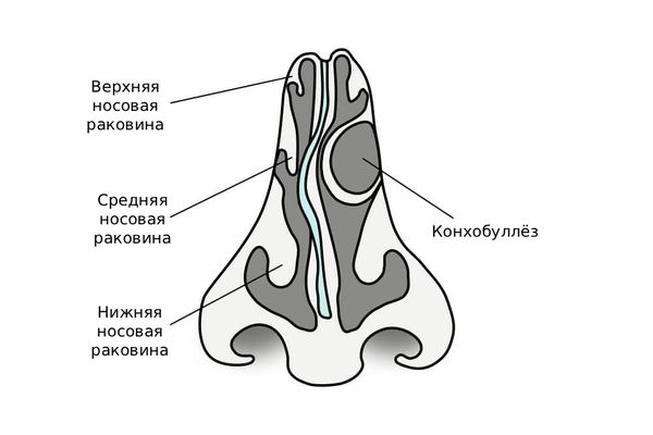 Конхобуллёз — один из видов аномалий строения полости носа