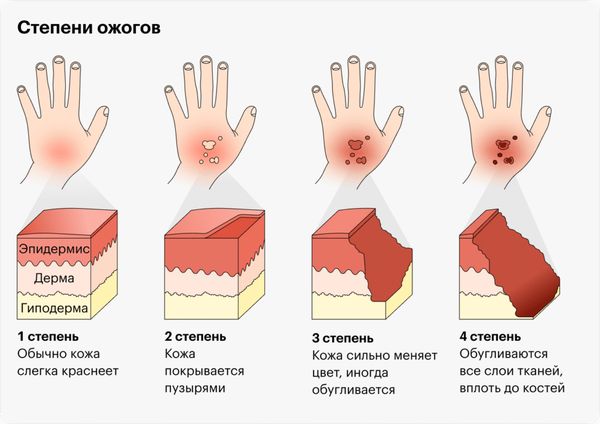 Степени ожога Степени ожога