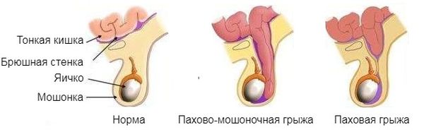 Два вида грыж