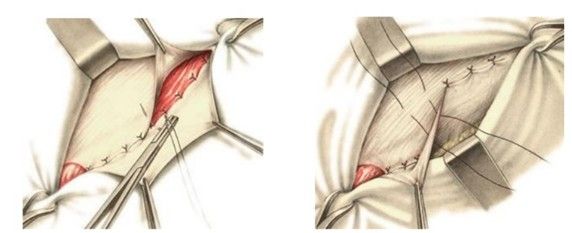 Пластика по Мартынову
