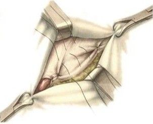 Пластика по Ру — Краснобаеву